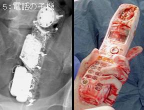 下腹部痛シリーズ Lower Abdominal Pain 15 症例 Le ７５