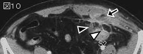下腹部痛シリーズ Lower Abdominal Pain 症例 Lr ９６