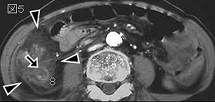 右下腹部痛（Right Lower Quadrant Pain）シリーズ12 【症例 RR 59】