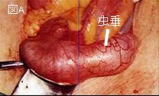 右下腹部痛（Right Lower Quadrant Pain）シリーズ13 【症例 RR ６２】