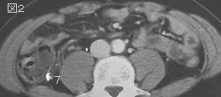 右下腹部痛 Right Lower Quadrant Pain シリーズ13 症例 Rr ６５