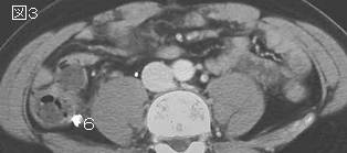 右下腹部痛 Right Lower Quadrant Pain シリーズ13 症例 Rr ６５