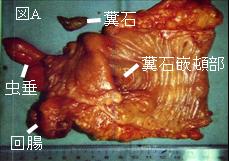 憩室炎 ひどい腹痛の原因かもしれません 元町 中華街の内科 ソージュ山下町内科クリニック