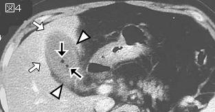 上腹部痛 Epigastric Pain シリーズ10 症例 Er ４６