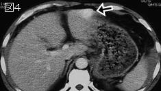 上腹部痛 Epigastric Pain シリーズ14 症例 Ee ６７