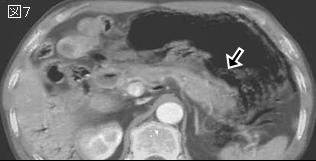 上腹部痛 Epigastric Pain シリーズ21 症例 Ee １０３