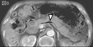 上腹部痛 Epigastric Pain シリーズ21 症例 Ee １０３