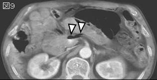 上腹部痛 Epigastric Pain シリーズ21 症例 Ee １０３