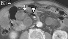 上腹部痛 Epigastric Pain シリーズ21 症例 Ee １０３